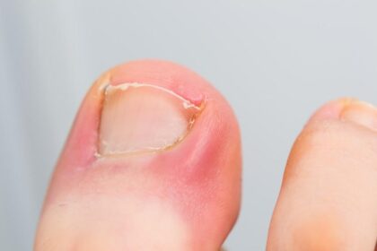 Ingrown Toenails
