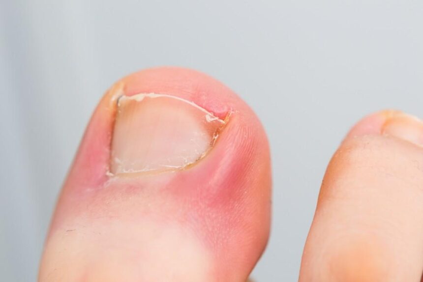 Ingrown Toenails