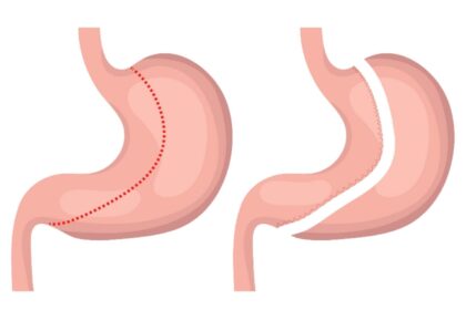 Gastric Sleeve Surgery