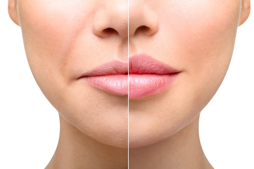Long-Term Effects of Dermal Fillers