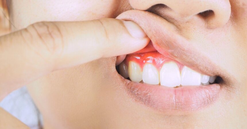 Periodontal Disease