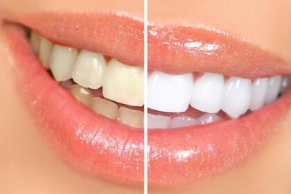 Teeth Whitening for Sensitive Teeth