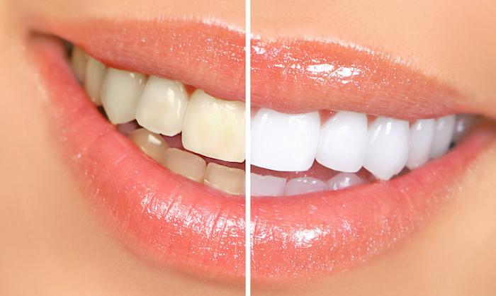 Teeth Whitening for Sensitive Teeth
