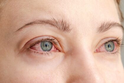 Allergies Can Affect Your Eyes and Vision