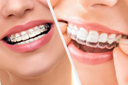 Braces Versus Clear Aligners