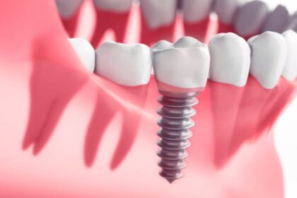 Dental Implants