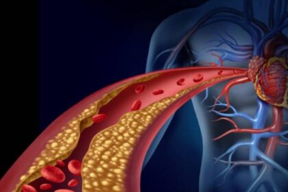 High Cholesterol and Heart Disease