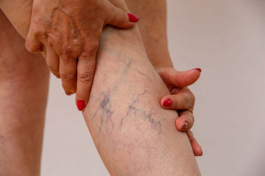 Identifying Varicose Veins