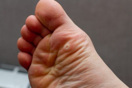 Treatments of Plantar Warts