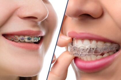 Differences Between Braces and Invisalign