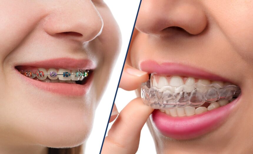 Differences Between Braces and Invisalign