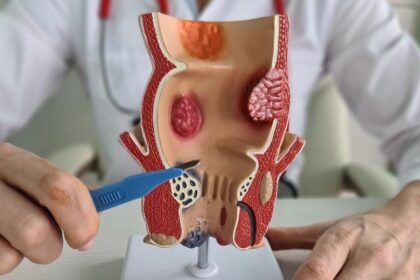 Lifestyle Changes for Hemorrhoids