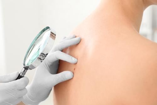 Preventing Skin Cancer