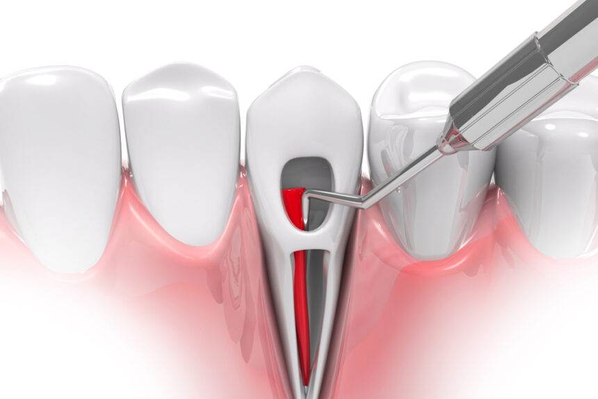 Root Canals