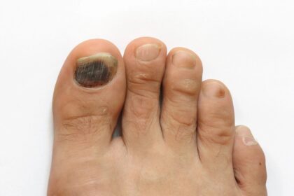 Toe Nail Fungus and Diabetes