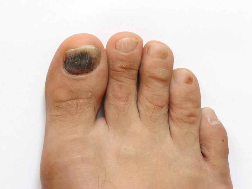 Toe Nail Fungus and Diabetes