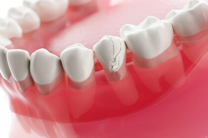 Treatments for Cracked Teeth