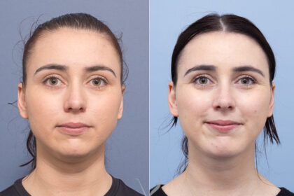 Neck Lift Surgery