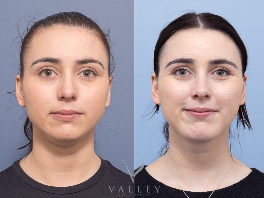 Neck Lift Surgery