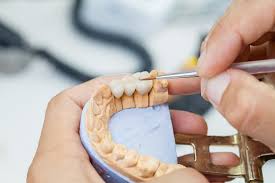 Dental Bridge