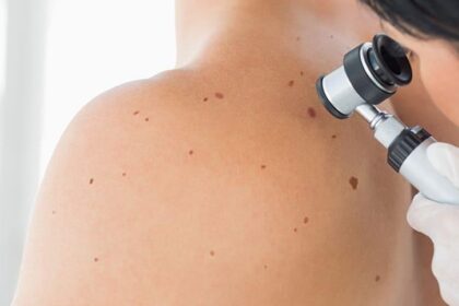 Role of a Dermatologist in Skin Cancer Prevention