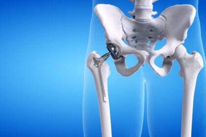 Hip Replacement Surgery