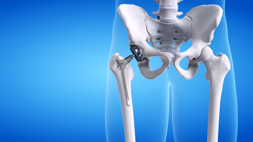 Hip Replacement Surgery