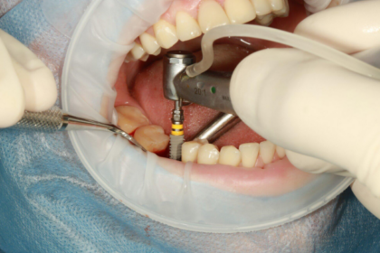 How Implants Help Prevent Common Problems Linked to Missing Teeth