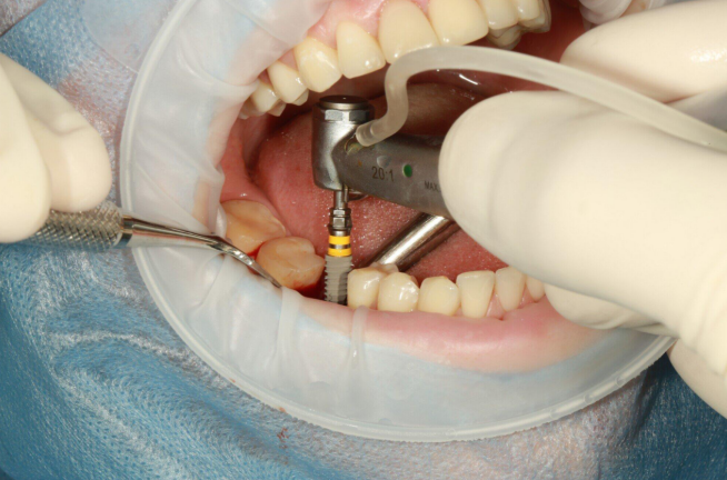 How Implants Help Prevent Common Problems Linked to Missing Teeth